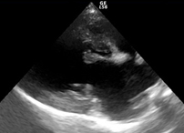 僧帽弁閉鎖不全症の心臓エコー所見